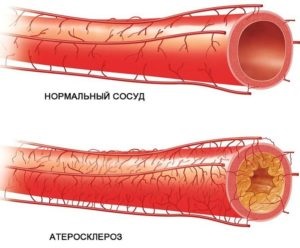 Összeszorítással atherosclerosis vagyis ezen vegyületek