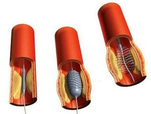 Összeszorítással atherosclerosis vagyis ezen vegyületek