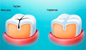 Képzés fogszuvasodás fejlesztése, az aktivitás mértéke, és a veszély, hogy az emberek (fok) Képzés fogszuvasodás fejlesztése, az aktivitás mértéke és a kockázat az emberi