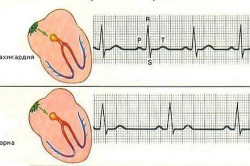 Tachycardia terhesség okai és kezelése