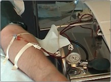 plazma szűrési technológia emberi vér - és kaszkád plazma szűréssel plazmaferézissel