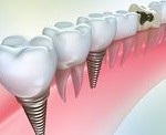 A fogászati implantáció technológia (implantáció) fogászati implantátumok Technology