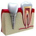 A fogászati implantáció technológia (implantáció) fogászati implantátumok Technology