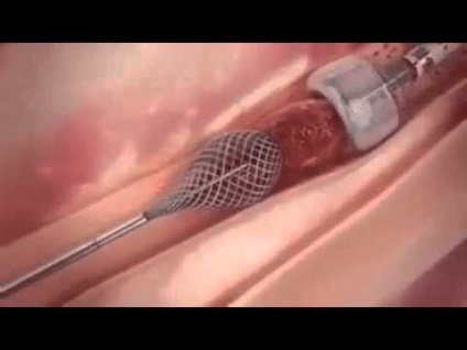 Eltávolítása a trombus a láb és az alsó végtagok thrombectomia (eltávolítás) Eltávolítása a vérrög a láb vagy thrombectomia az alsó végtagok