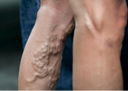 Eltávolítása a vérrög a láb vagy thrombectomia az alsó végtagok (lábak) Eltávolítása a vérrög a láb vagy thrombectomia az alsó végtagok