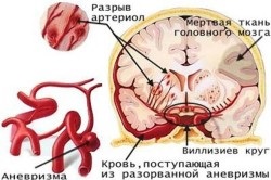Gyakorlatok a stroke után otthon (home) Gyakorlatok a stroke utáni otthon