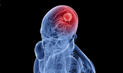 Gyakorlatok a stroke után otthon (gyakorlat) Gyakorlatok a stroke utáni otthon