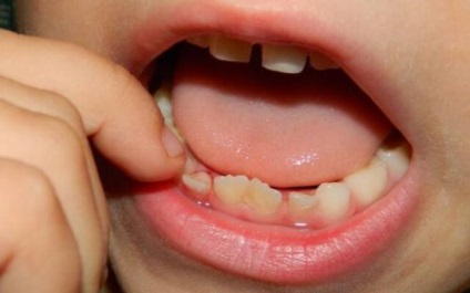 У дитини хитається молочний зуб що робити, як правильно висмикнути