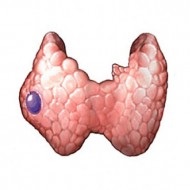 Pajzsmirigy adenoma, follikuláris neoplazma, toxikus