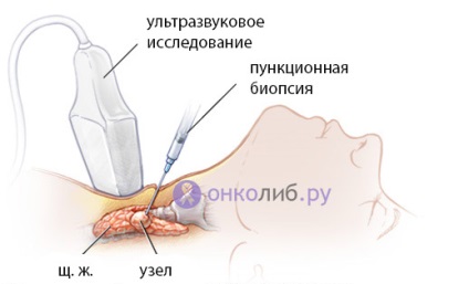 Pajzsmirigy adenoma, follikuláris neoplazma, toxikus