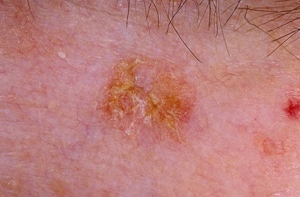 Aktinikus Keratosis diagnózis, kezelés (kitett bőr) Aktinikus Keratosis diagnózis, kezelés