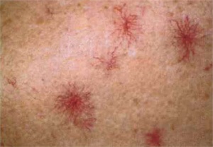 Allergiás bőr vasculitis kezelésére és tünetek