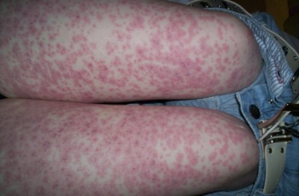 Allergiás vasculitis kezelésére és tünetek