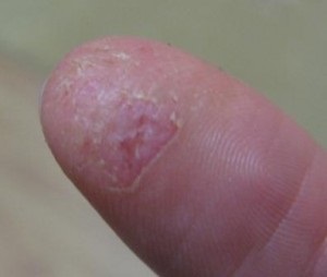 Allergia zselés köröm, allergiák (allergiás Nail Gel) Allergia gél körmök, allergiás