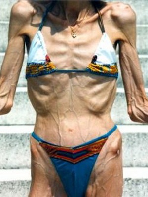 Anorexia - mi ez fotóeffektus anorexia, amelyhez vezet