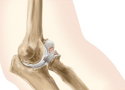 Osteoarthritis a könyök - kezelése népi jogorvoslati