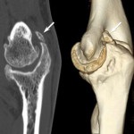 Osteoarthritis a könyök otthoni kezelés