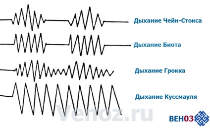 Álmatlanságkezelés alvászavarok stroke után, gyógyászati ​​sze-va