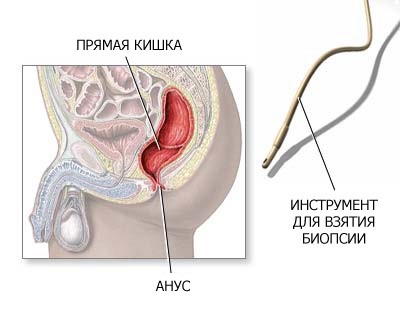 A biopszia a végbél - Egészségügyi információk (közvetlen) A biopszia a végbél - Egészség Információk