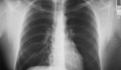 Bronchitis a röntgen (gyermekek és felnőttek) átirata, leírása