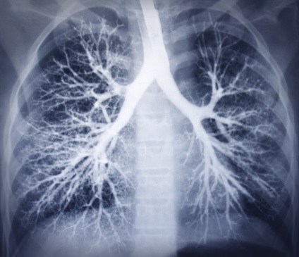 Bronchitis a röntgen nézetek és hogyan lehet megkülönböztetni (bronchitis) Bronchitis a röntgen nézetek és hogyan lehet megkülönböztetni