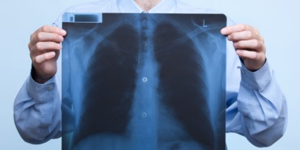 Bronchitis a röntgen nézetek és hogyan lehet megkülönböztetni