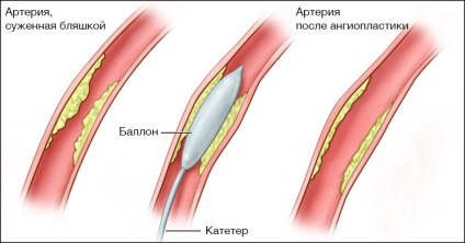Gyakran ismételt kérdések a ballonos angioplasztika, stent és a stentbeültetés válaszok (stent) Gyakran ismételt kérdések a ballonos angioplasztika, stent és a stentbeültetés válaszok