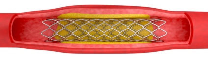 Gyakran ismételt kérdések a ballonos angioplasztika, stent és a stentbeültetés válaszok (stenting) Gyakran ismételt kérdések a ballonos angioplasztika, stent és a stentbeültetés válaszok