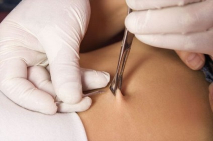 A veszélyes 1 köldök piercing (szúró) Mennyire veszélyes köldök piercing 1