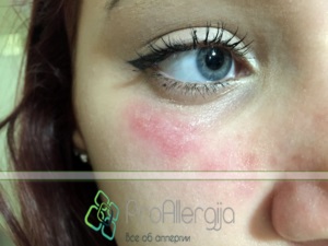 Mi a teendő, ha allergiás a kozmetikumok a szemét