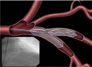 Mi a ballonos angioplasztika stenttel