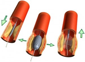 Mi a ballonos angioplasztika stenttel