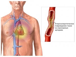 Mi a ballonos angioplasztika stenttel
