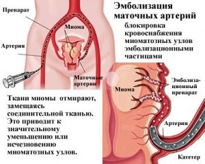 Mi méhartérián embolizáció a méhmióma vélemények