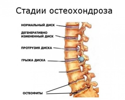 Mi osteochondrosis koncepció lehetséges mértékig kezelés (osteochondrosis) Mi osteochondrosis koncepció mértékben lehetséges kezelési