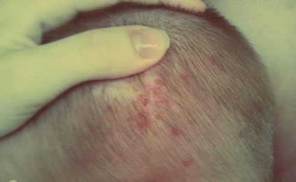 Mi streptoderma és hogyan kell kezelni azt (bőrterületek) Mi streptoderma és hogyan kell kezelni azt