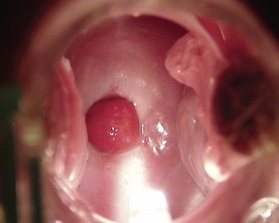 Decidualis polip - egy terhességi szövődmény (fotó)