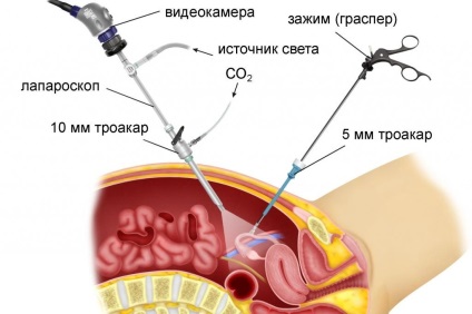 Diagnosztikus laparoszkópia ár Moszkva (diagnosztikus) Diagnosztikus laparoszkópia ár Moszkvában