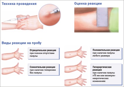 Diaskintest (alternatív Mantoux-teszt)