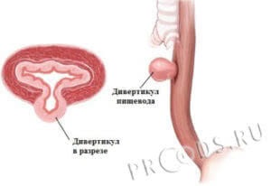 Divertikulum a nyelőcső okoz, tünetei, diagnózisa, kezelése (diverticulumok) Diverticulum a nyelőcső okok, tünetek, diagnózis, kezelés
