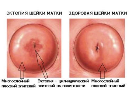 Ектопія (псевдоерозія) шийки матки причини, лікування, ускладнення