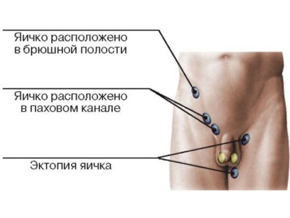 Testicularis ectopia mi ez, és úgy néz ki, mint a fotó, mint egy szalagos ágyék és más típusú méhen kívüli