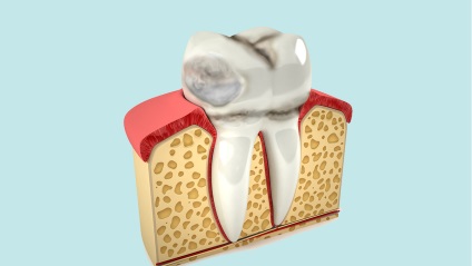 Erózió a fogzománcot, annak okait és kezelésére felnőtt