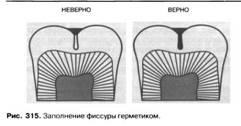 Barázdazárók (tömítőanyagok) (hasadék) Barázdazárók (tömítőanyagok)