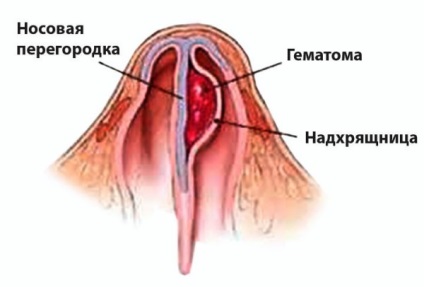 Vérömleny az orrsövény - mit kell tenni