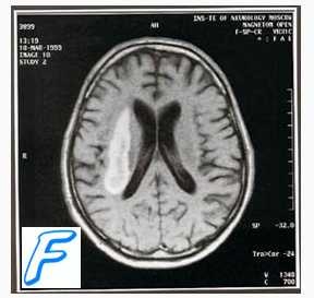 Vérzéses stroke 1 (vérzéses stroke) Vérzéses stroke 1