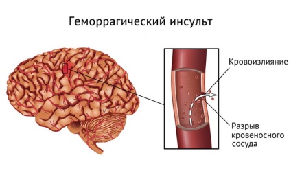 Vérzéses stroke tünetek, az okok (vérzéses) Vérzéses stroke tünetek, az okok a
