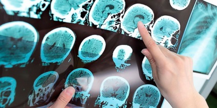 Vérzéses stroke tünetek, az okok (a kamrák az agy) Vérzéses stroke tünetek, az okok a
