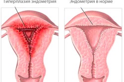 Endometrium hiperplázia kezelése népi jogorvoslati