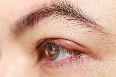 Betegségek, amiket a csipás szem jelez